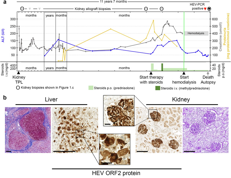
戊型肝炎腎移植受者膜增殖型免疫復合物腎小球腎炎的臨床過程、尸檢結(jié)果和逐漸發(fā)展