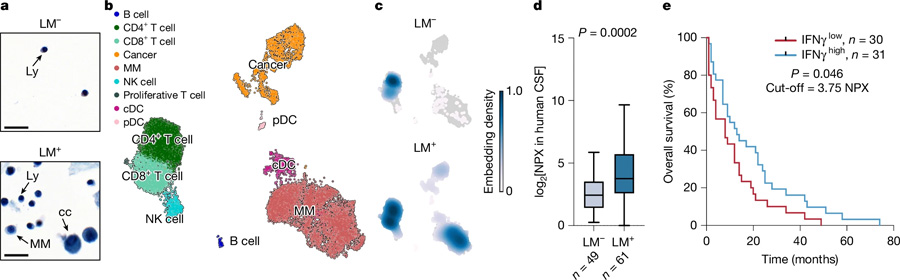炎癥誘導的腦脊液細胞增多見于軟腦膜轉(zhuǎn)移患者 炎癥誘導的腦脊液細胞增多見于軟腦膜轉(zhuǎn)移患者
