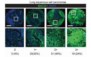 CRISPR激活篩選揭示BACE1驅(qū)動非小細(xì)胞肺癌腦轉(zhuǎn)移的機制及治療潛力