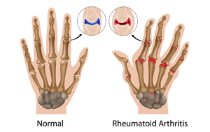中性粒細胞與白蛋白比率（NPAR）：類風(fēng)濕關(guān)節(jié)炎骨質(zhì)疏松風(fēng)險的新型預(yù)測因子及其臨床轉(zhuǎn)化價值