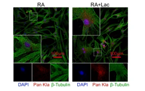 組蛋白乳酸化修飾通過上調(diào)NFATc2表達(dá)及抗乳酸化組蛋白自身抗體促進(jìn)類風(fēng)濕關(guān)節(jié)炎進(jìn)展