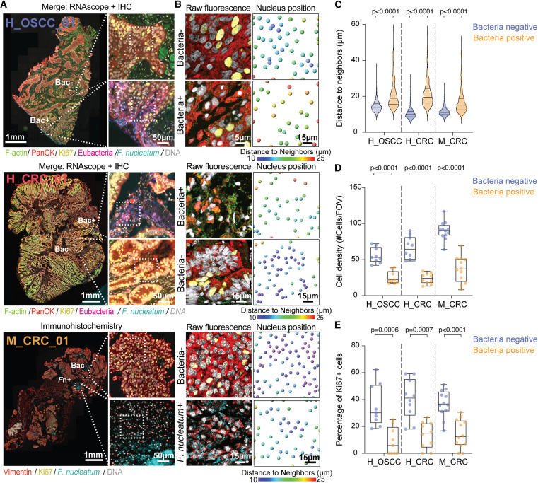 細(xì)菌感染微灶內(nèi)癌細(xì)胞的空間分布 細(xì)菌感染微灶內(nèi)癌細(xì)胞的空間分布