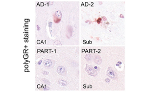 阿爾茨海默病新病理機制：polyGR蛋白聚集物關(guān)聯(lián)Aβ斑塊與pTau纏結(jié)并受氧化應(yīng)激調(diào)控
