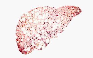 Cell：高脂飲食迫使肝細(xì)胞自保，卻最終誘發(fā)肝癌