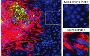 Science Advances：卵巢癌在腹腔內(nèi)迅速擴(kuò)散，原來(lái)是有幫兇