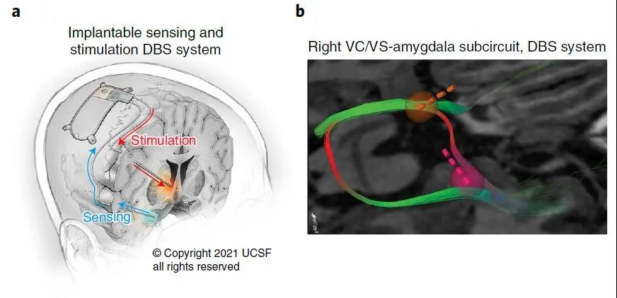 腦電刺激成功拯救重度抑郁癥患者，治愈抑郁癥時(shí)代離我們不遠(yuǎn)了？