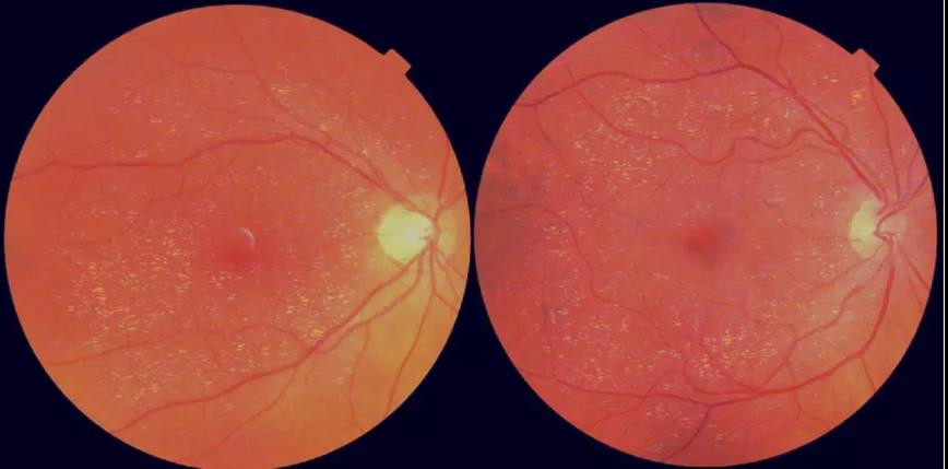 眼睛竟是“年齡之窗”？視網(wǎng)膜年齡差距或可預(yù)測壽命長短