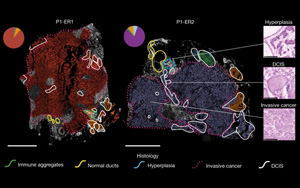 Nature：利用空間基因組學來了解乳腺癌克隆如何進化