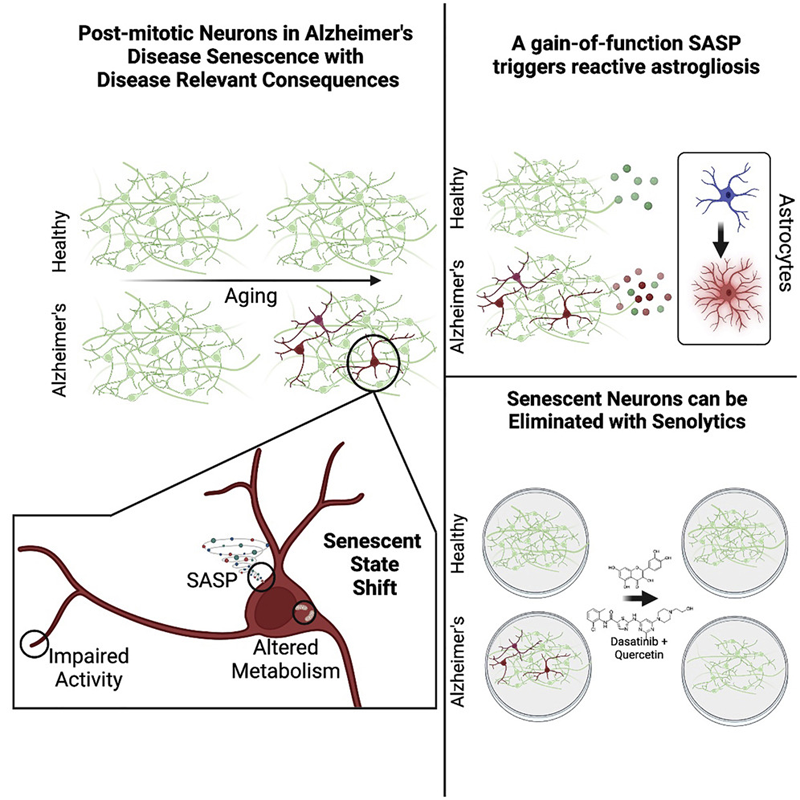阿爾茨海默病衰老神經(jīng)元有絲分裂后與相應(yīng)的疾病后果