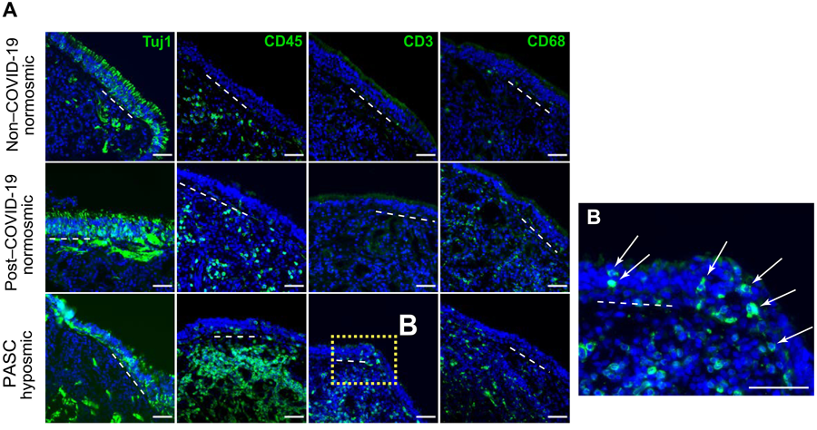 新冠肺炎急性后遺癥嗅覺粘膜下丘組織學(xué)評估提示T細(xì)胞浸潤的作用 新冠肺炎急性后遺癥嗅覺粘膜下丘組織學(xué)評估提示T細(xì)胞浸潤的作用