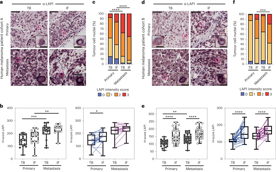 LAP1水平在人類黑色素瘤進展中增加 LAP1水平在人類黑色素瘤進展中增加