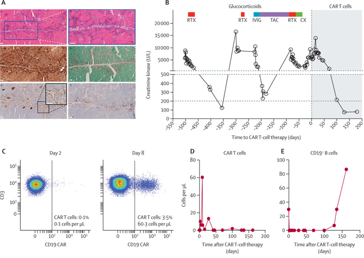 CAR T細(xì)胞對(duì)抗突觸綜合征表現(xiàn)的影響 CAR T細(xì)胞對(duì)抗突觸綜合征表現(xiàn)的影響