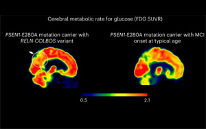 Nature Medicine發(fā)現(xiàn)了新的基因變異，可以預(yù)防阿爾茨海默病