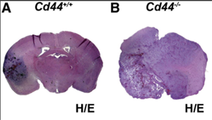 肺癌腦轉(zhuǎn)移的新機制