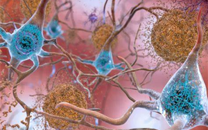 阿爾茨海默病:斑塊里不僅有tau和淀粉樣蛋白 還有衰老驅(qū)動(dòng)的數(shù)百種蛋白質(zhì)積聚 解密之鑰或藏其中