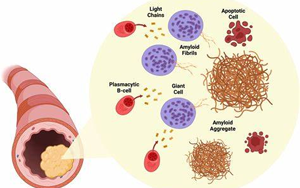 NEJM綜述：淀粉樣變性的發(fā)病機制、研究和治療